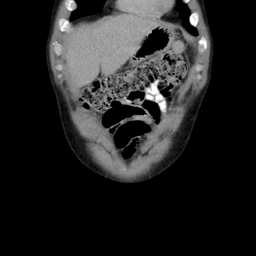 File:Appendicitis complicated by post-operative collection (Radiopaedia 35595-37113 B 12).jpg