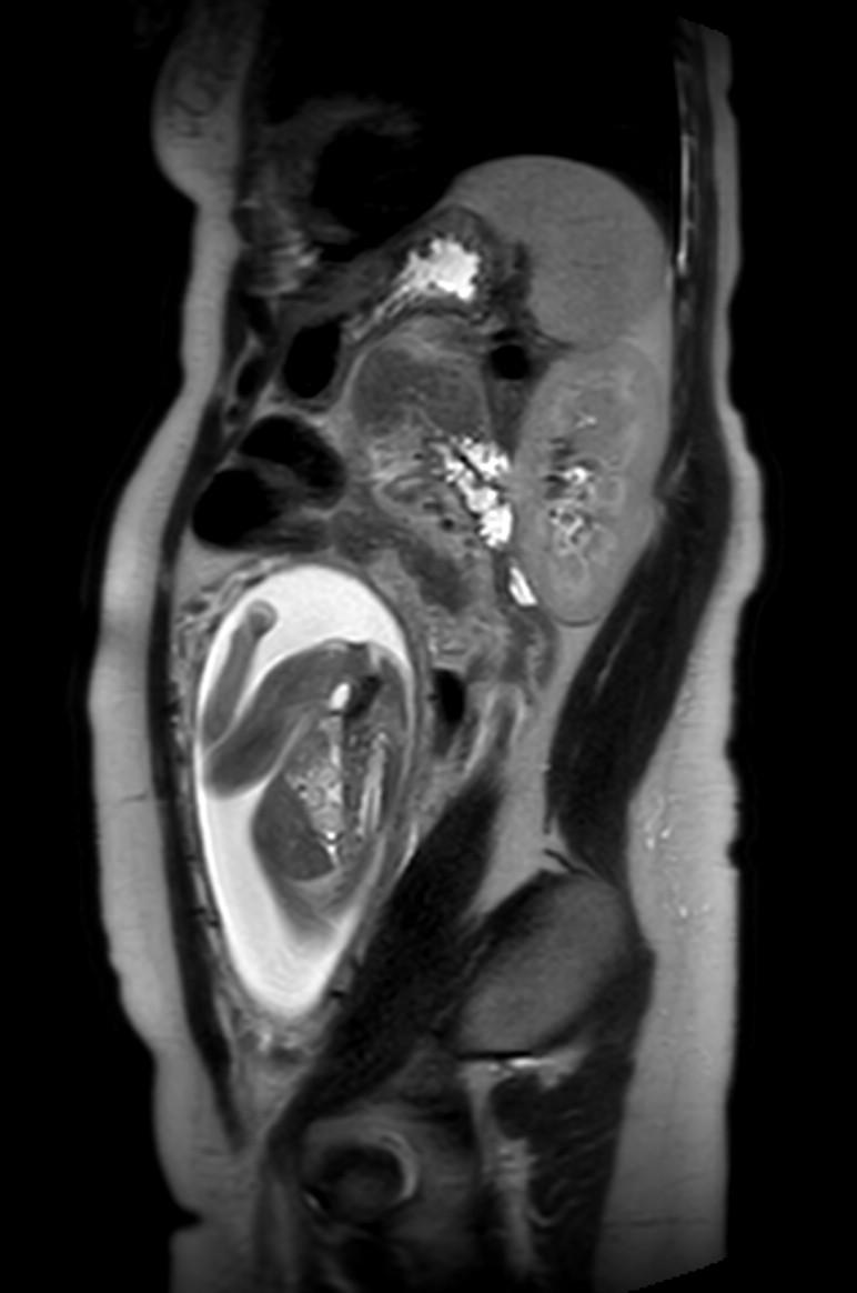 Appendicitis in gravida (MRI) (Radiopaedia 89433-106395 Sagittal T2 21).jpg