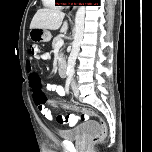File:Appendicitis mass in inguinal hernia (Radiopaedia 26858-27029 C 28).jpg