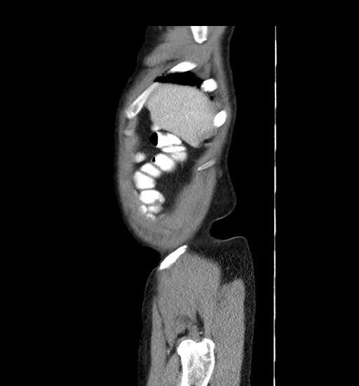Appendicitis with localized perforation and abscess formation (Radiopaedia 49035-54130 C 5).jpg