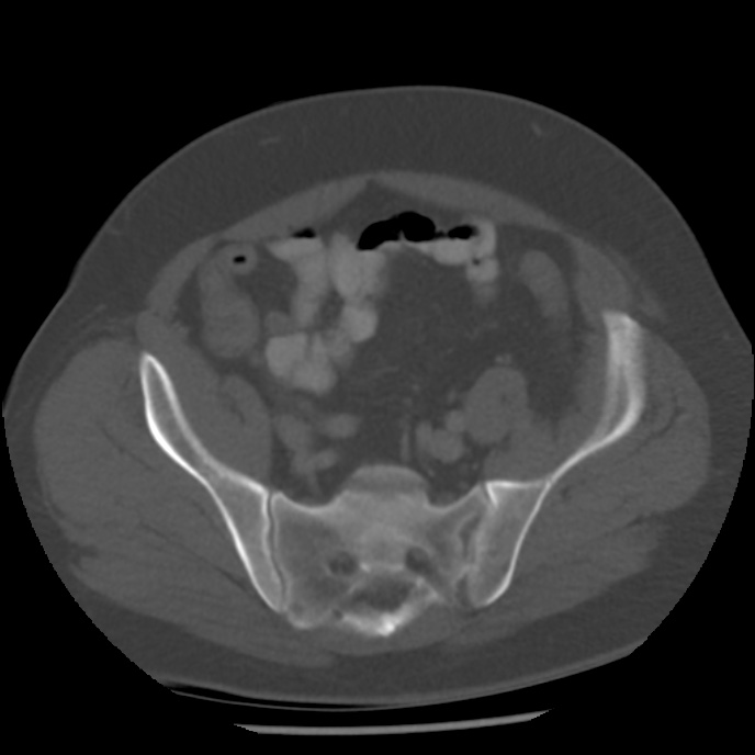 Appendicitis with perforation (Radiopaedia 35790-37342 Axial bone window 41).jpg