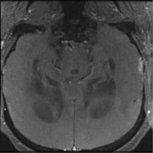 File:Aqueduct stenosis with corpus callosum hypoattenuation post shunting (Radiopaedia 37212-38969 Axial CSF Flow 34).png