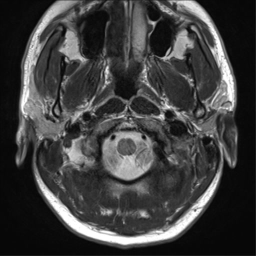 File:Arachnoid cyst - cerebellopontine angle (Radiopaedia 59689-67083 Axial T2 6).png