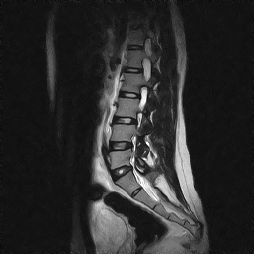 File:Arachnoid cyst - spinal (Radiopaedia 66835-76157 Sagittal T2 8).jpg