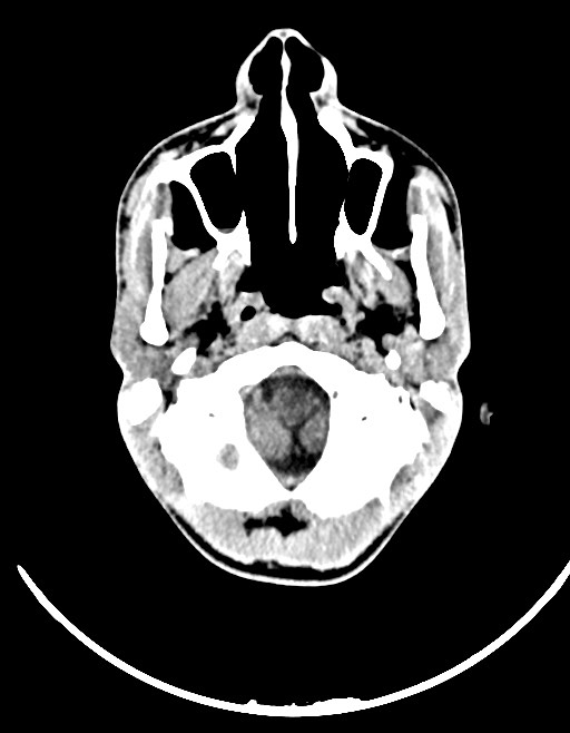 Arrow injury to the brain (Radiopaedia 72101-82607 Axial non-contrast 50).jpg