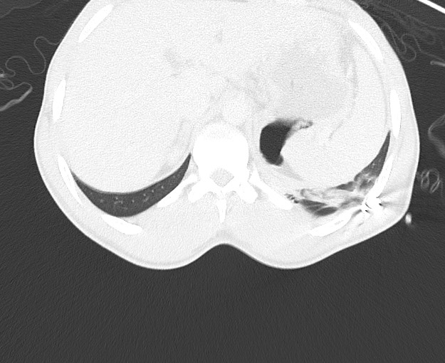 File:Arrow injury to the chest (Radiopaedia 75223-86321 Axial lung window 99).jpg