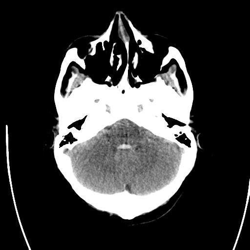 File:Arteriovenous malformation (cerebral) (Radiopaedia 40070-42579 Axial non-contrast 8).png