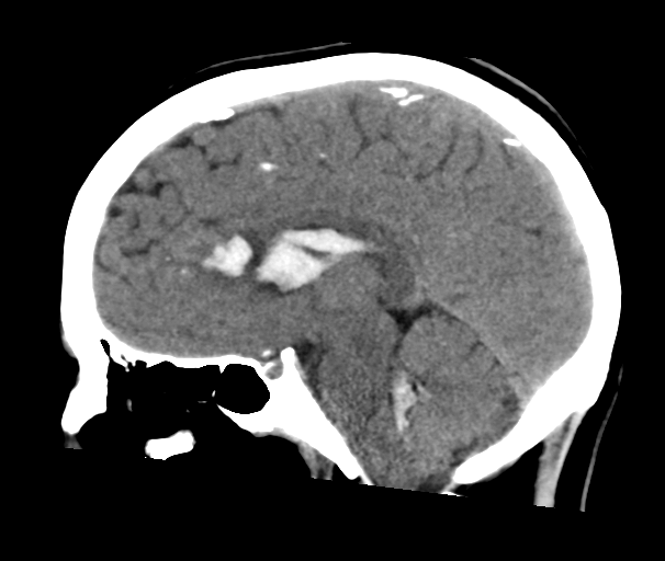 File:Arteriovenous malformation (cerebral) (Radiopaedia 40070-42579 B 16).png