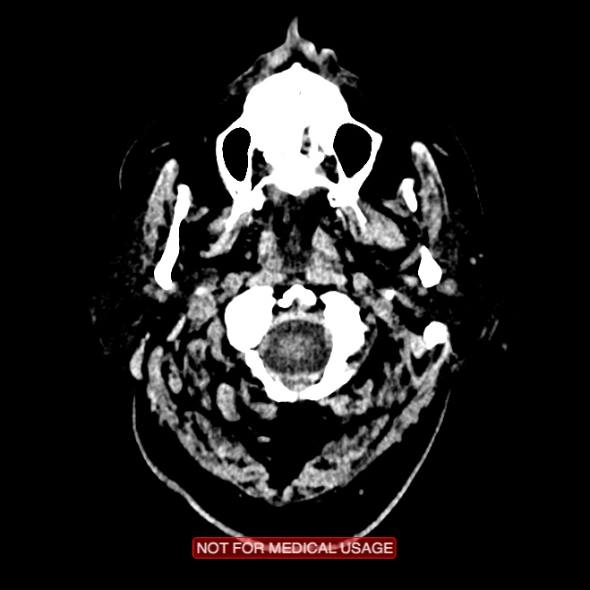 Artery of Percheron infarction (Radiopaedia 28679-28967 Axial non-contrast 3).jpg