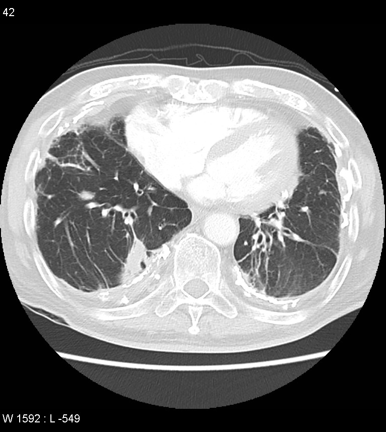 Asbestos related lung and pleural disease (Radiopaedia 14377-14301 A 39).jpg