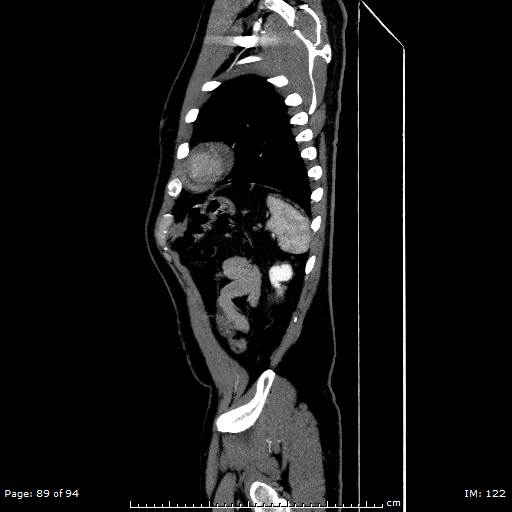 Ascending aortic aneurysm (Radiopaedia 50086-55404 C 63).jpg