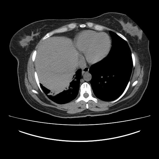 File:Ascending retrocecal appendicitis with liver abscesses (Radiopaedia 60066-67615 Axial non-contrast 6).jpg