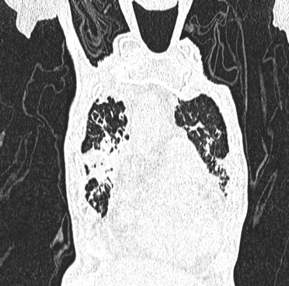 File:Aspergilloma- with Monod sign (Radiopaedia 44737-48532 Coronal lung window 142).jpg