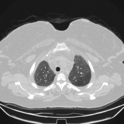 Aspergilloma (Radiopaedia 39611-41932 Axial lung window 21).jpg