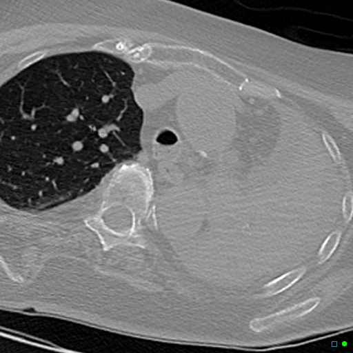 File:Aspirated food bolus obstruction of left main bronchus (Radiopaedia 29432-29904 Axial non-contrast 8).jpg