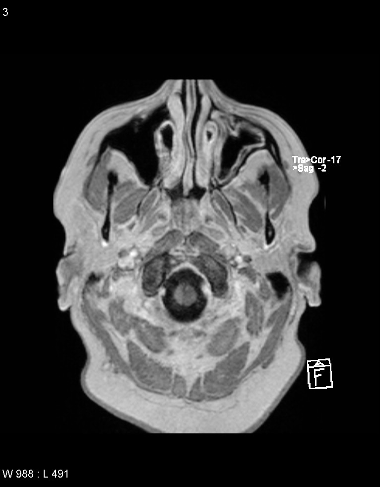 Astroblastoma (Radiopaedia 39792-42217 Axial T1 C+ 2).jpg