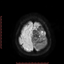 Astroblastoma (Radiopaedia 74287-85162 Axial DWI 100).jpg