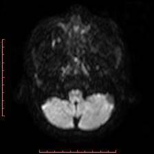 Astroblastoma (Radiopaedia 74287-85162 Axial DWI 7).jpg