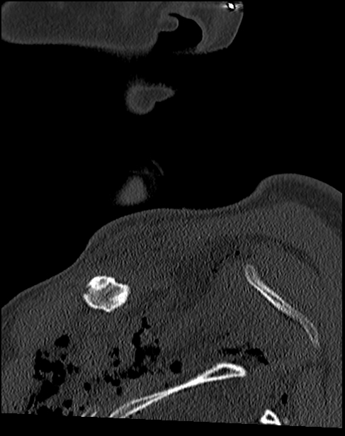 Atlanto-occipital dissociation - Traynelis type 1 (Radiopaedia 87570-103948 Sagittal bone window 6).jpg