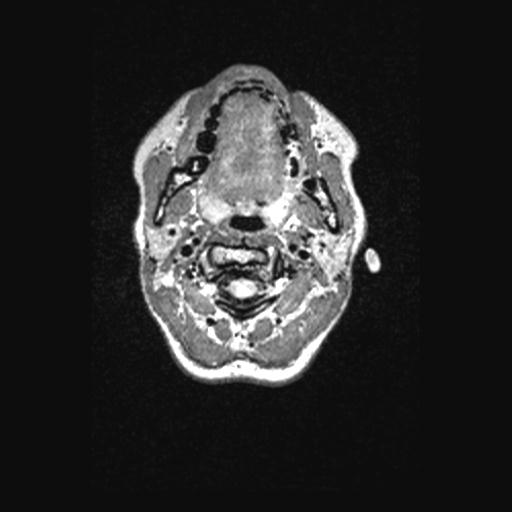 Atretic encephalocoele with inferior vermis hypoplasia (Radiopaedia 30443-31108 Axial 3).jpg
