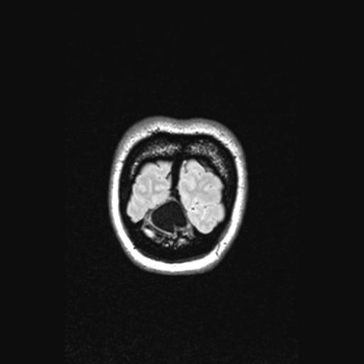 File:Atretic encephalocoele with inferior vermis hypoplasia (Radiopaedia 30443-31108 Coronal FLAIR 19).jpg