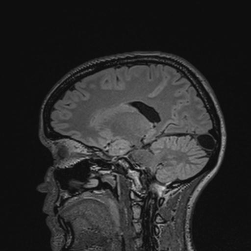 Atretic encephalocoele with inferior vermis hypoplasia (Radiopaedia 30443-31108 Sagittal FLAIR 96).jpg