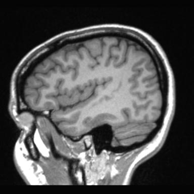 Atretic encephalocoele with inferior vermis hypoplasia (Radiopaedia 30443-31108 Sagittal T1 26).jpg
