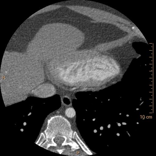 File:Atrial septal defect (upper sinus venosus type) with partial anomalous pulmonary venous return into superior vena cava (Radiopaedia 73228-83961 A 240).jpg