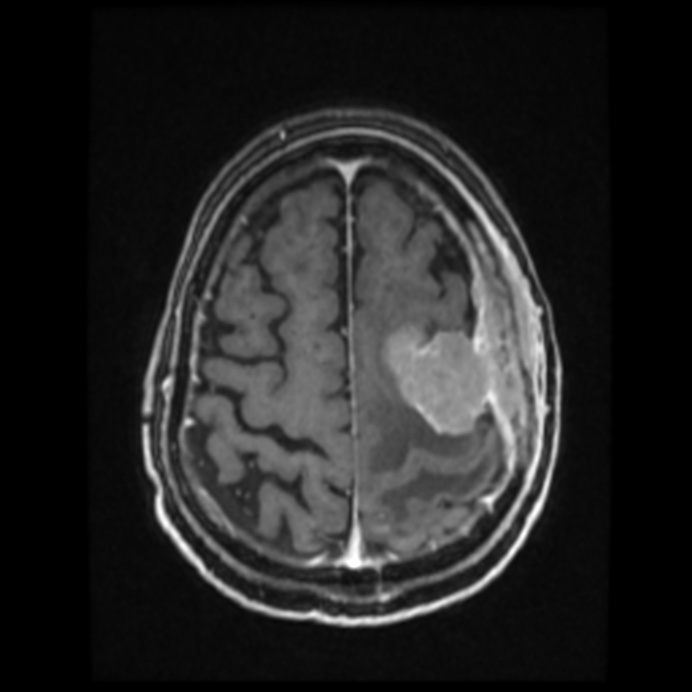 Atypical meningioma (Radiopaedia 45535-49629 Axial T1 C+ 54).jpg