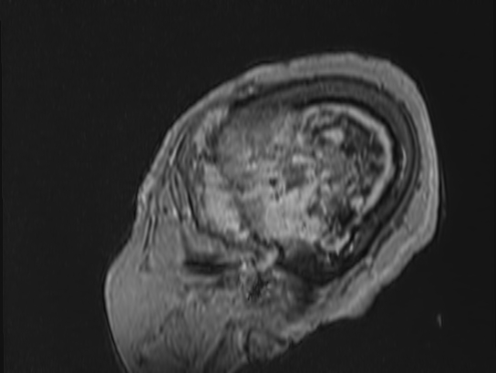 Atypical meningioma (Radiopaedia 62985-71406 Sagittal T1 C+ 93).jpg