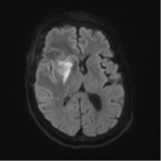 Atypical meningioma (WHO Grade II) (Radiopaedia 54742-60981 Axial DWI 43).png