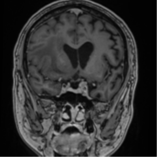 Atypical meningioma (WHO grade II) with brain invasion (Radiopaedia 57767-64729 Coronal T1 C+ 34).png