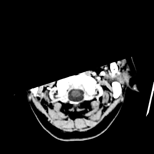 File:Atypical meningioma with skull invasion (Radiopaedia 34357-35649 Axial C+ delayed 4).png