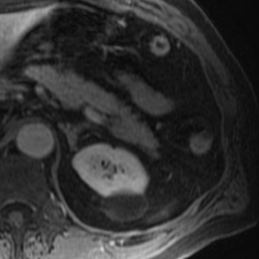 File:Atypical renal cyst on MRI (Radiopaedia 17349-17046 D 7).jpg