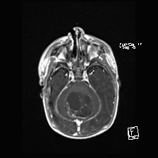Atypical teratoid rhabdoid tumor (prenatal US and neonatal MRI) (Radiopaedia 59091-66388 Axial T1 C+ 19).jpg