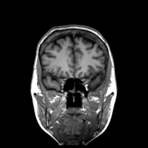 Autoimmune limbic encephalitis (Radiopaedia 30363-31005 Coronal T1 42).jpg