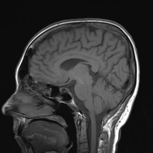 File:Autoimmune limbic encephalitis (Radiopaedia 30363-31005 Sagittal T1 12).jpg