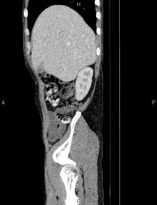 Autoimmune pancreatitis (Radiopaedia 84925-100431 E 17).jpg