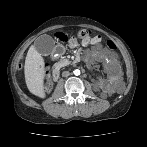 Autosomal dominant polycystic kidney disease (Radiopaedia 27851-28094 B 74).jpg