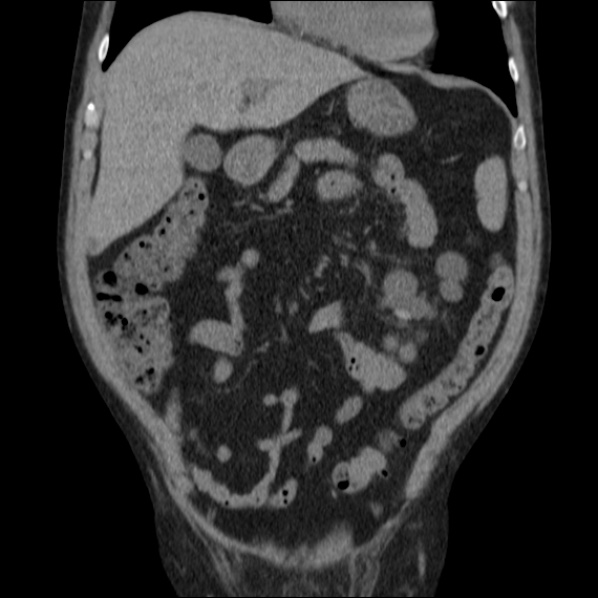 Autosomal dominant polycystic kidney disease (Radiopaedia 36539-38101 C 24).jpg