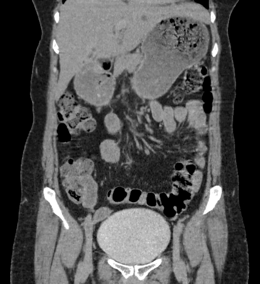 Autosomal dominant polycystic kidney disease (Radiopaedia 38189-40194 Coronal C+ delayed 23).jpg