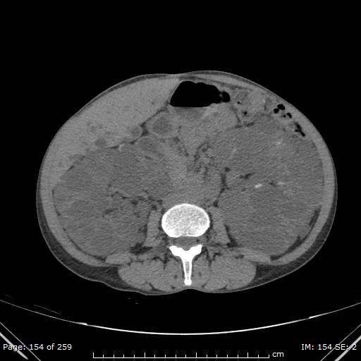 File:Autosomal dominant polycystic kidney disease (Radiopaedia 44122-47684 Axial non-contrast 55).jpg
