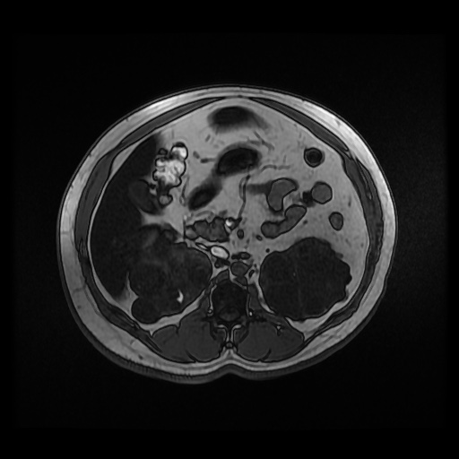 Autosomal dominant polycystic kidney disease (Radiopaedia 50259-55611 Axial 2D Dual Echo 41).jpg