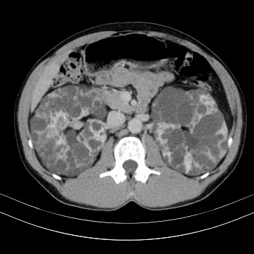 Autosomal dominant polycystic kidney disease (Radiopaedia 66349-75582 B 37).jpg