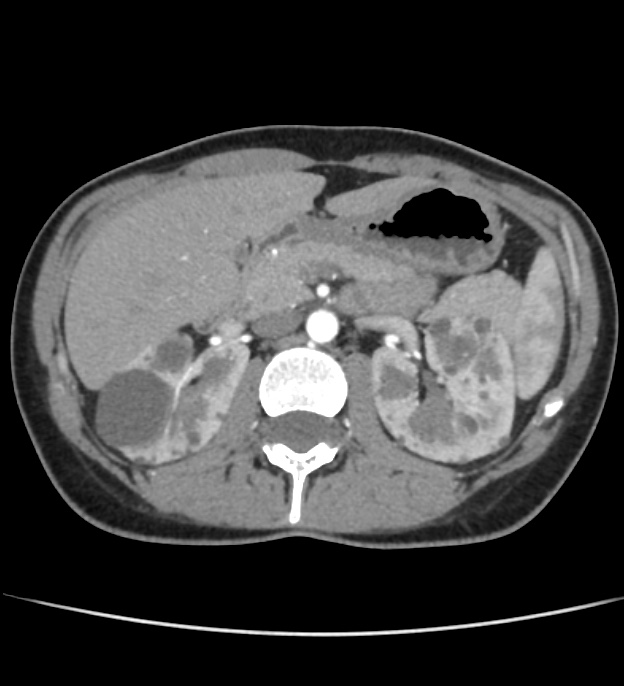 Autosomal dominant polycystic kidney disease - early onset (Radiopaedia 40734-43387 B 18).jpg