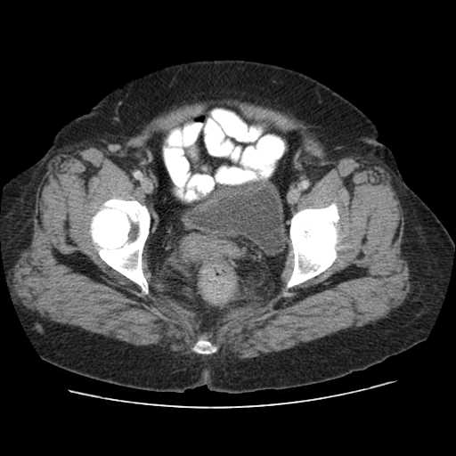 Autosomal dominant polycystic kidney disease with hepatic involvement (Radiopaedia 32693-33662 B 76).jpg