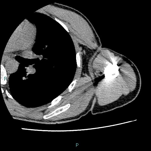 File:Avascular necrosis after fracture dislocations of the proximal humerus (Radiopaedia 88078-104655 D 86).jpg