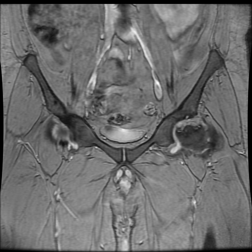 Avascular necrosis of the hip (Radiopaedia 61503-69465 F 27).jpg