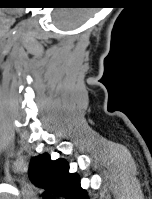Axis peg fracture (type 3) and atlas lateral mass (type 4) fracture (Radiopaedia 37474-39324 D 57).png