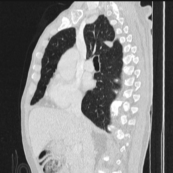Azygos lobe (Radiopaedia 38259-40275 lung window 45).jpg